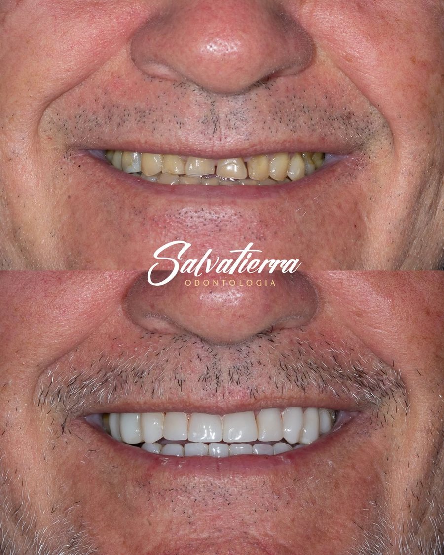 Diagnóstico e conclusão de reabilitação estética anterior
