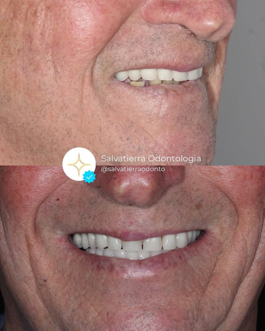 Diagnóstico e conclusão de reabilitação com dentes fixos